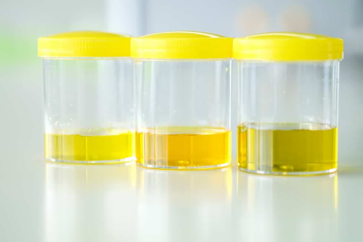 What are the Best Urine Test Strips for Ketosis?