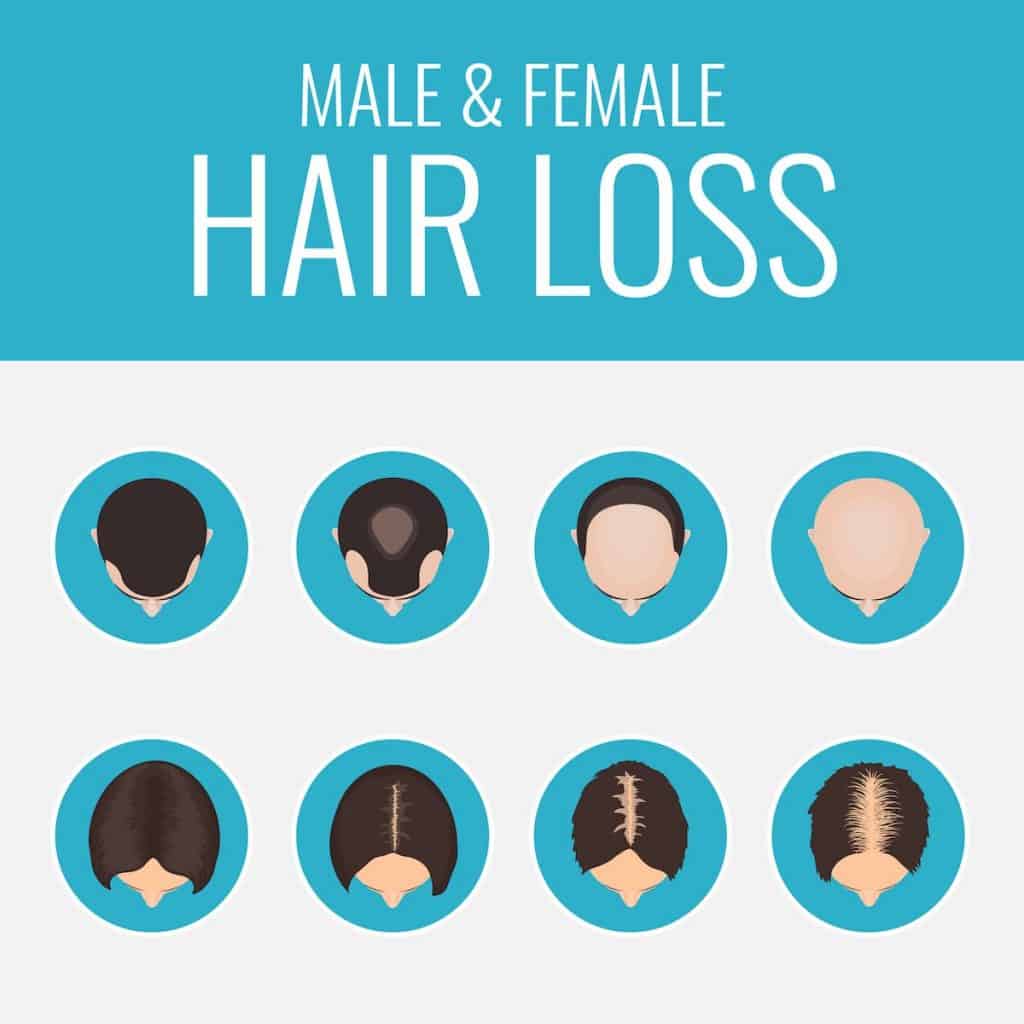 Male and female hair loss set showing women and men hair loss areas over time - hair loss on keto diet